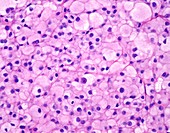Balloon cell melanoma, light micrograph