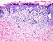 Melanoma depth of invasion, light micrograph