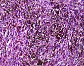 Pigmented melanoma, light micrograph