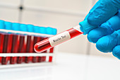 Measles blood test, conceptual image