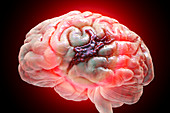 Brain haemorrhage, illustration