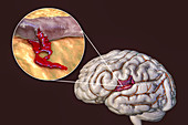 Haemorrhagic stroke, illustration