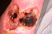 Leg ucler from necrotising vasculitis