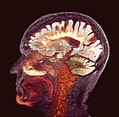 Multiple sclerosis, sagittal brain MRI scan