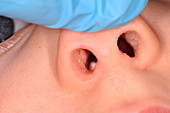 Foreign body in child's nose