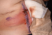 Infected surgical wound