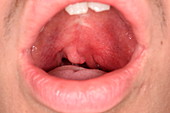 Infected tonsil