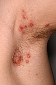 Bullous impetigo