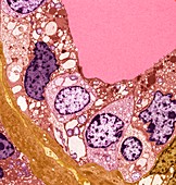 Thyroid cancer, TEM