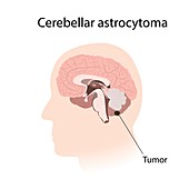 Cerebellar astrocytoma, illustration