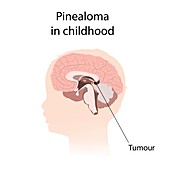 Pinealoma in childhood, illustration