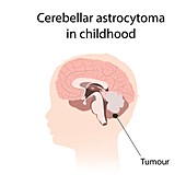 Cerebellar astrocytoma in childhood, illustration
