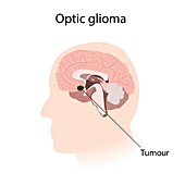 Optic glioma, illustration