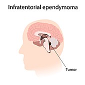 Infratentorial ependymoma, illustration