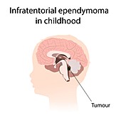 Infratentorial ependymoma in childhood, illustration