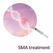 Spinal muscular atrophy treatment, illustration