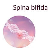 Spina bifida, illustration