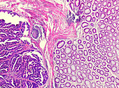 Carcinoid tumour of the colon, light micrograph