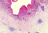 Pseudomembranous colitis, light micrograph