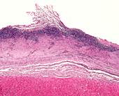 Bacterial myocarditis, light micrograph