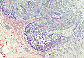 Basal cell carcinoma of the skin, light micrograph