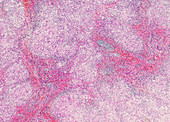 Micronodular cirrhosis of the liver, light micrograph