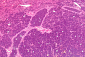 Lobar pneumonia grey hepatisation, light micrograph