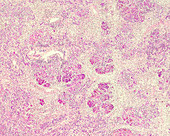 Subacute hepatitis, light micrograph