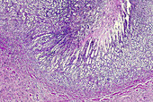 Human primary signet ring cell carcinoma, light micrograph
