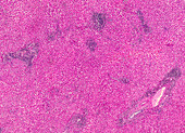 Sarcomatoid carcinoma, light micrograph