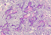 Human lymphoma, light micrograph