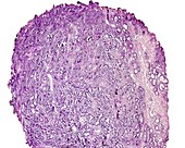 Prostate adenocarcinoma, light micrograph