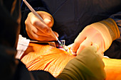 Spinal decompression surgery