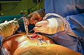 Spinal decompression surgery