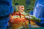 Spinal decompression surgery