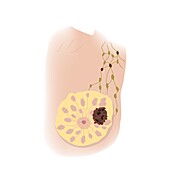 Breast cancer at stage T3, illustration