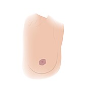 Changes in nipple shape, illustration