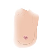 Nipple inversion, illustration