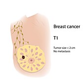 Breast cancer at stage T1, illustration