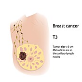Breast cancer at stage T3, illustration