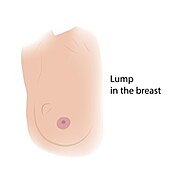 Breast lump, illustration