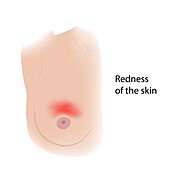Skin redness on female breast, illustration