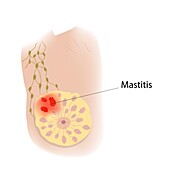 Mastitis, illustration