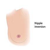 Nipple inversion, illustration
