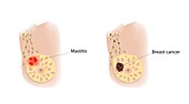 Mastitis and cancer, illustration