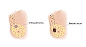 Fibroadenoma and breast cancer, illustration