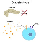 Diabetes type 1, illustration