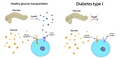 Diabetes type 1 and healthy glucose metabolism, illustration