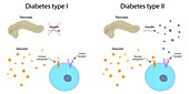 Diabetes type 1 and 2, illustration