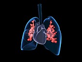 Viral lung infection, illustration
